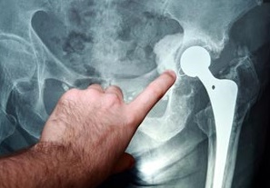 Перелом шейки бедра лечение рентген