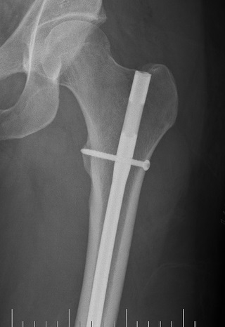 Перелом бедренной кости рентген