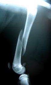 Перелом бедренной кости рентген