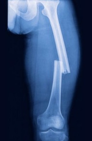 Перелом бедренной кости рентген снимок