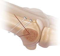 Вальгусная деформация пальца стопы лечение