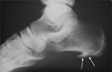 Пяточная шпора фото рентген