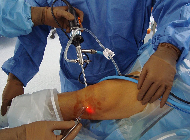 Артроскопия коленного сустава лечение